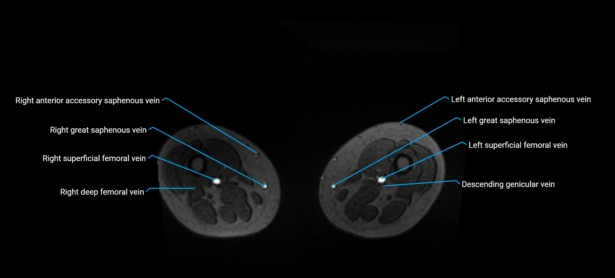 MRV abdomen pelvis & lower limb axial cross sectional anatomy labelled MRI image 308.webp